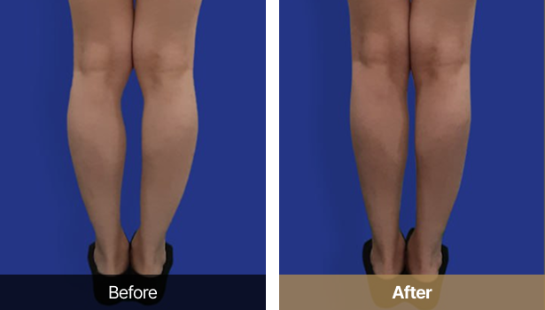 시술전후이미지