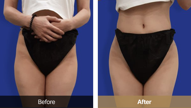 시술전후이미지