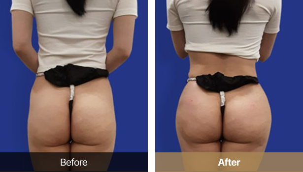 시술전후이미지