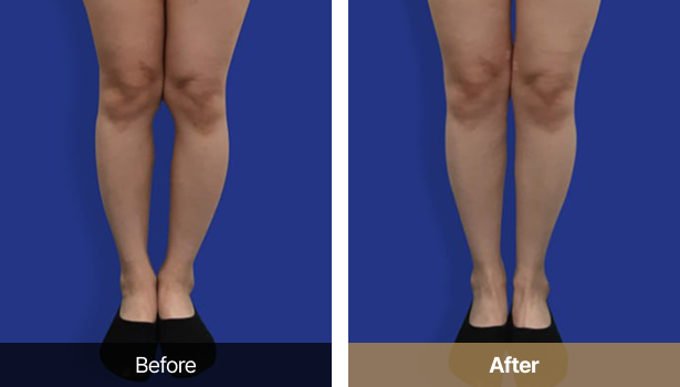 시술전후이미지