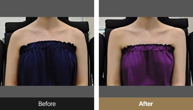 시술전후이미지