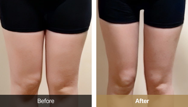 시술전후이미지