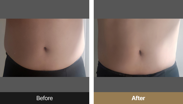 시술전후이미지