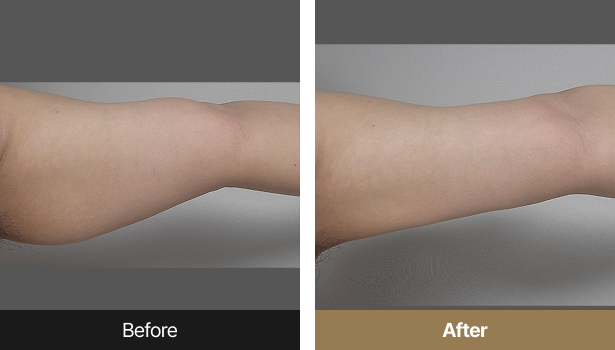 시술전후이미지