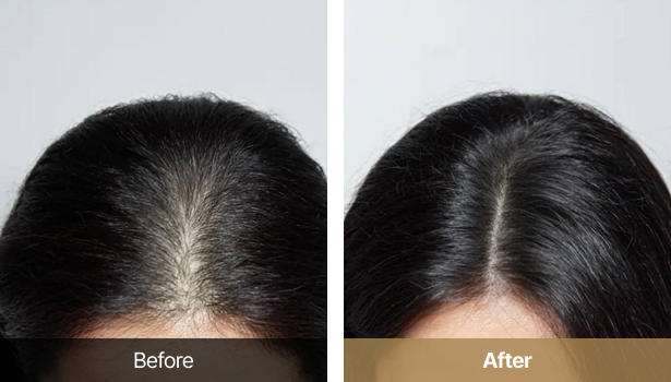 시술전후이미지