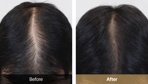 시술전후이미지