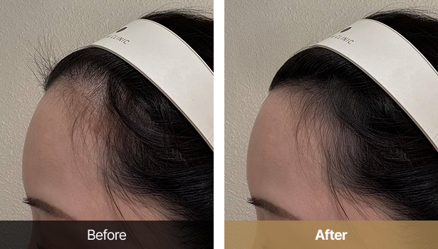 시술전후이미지