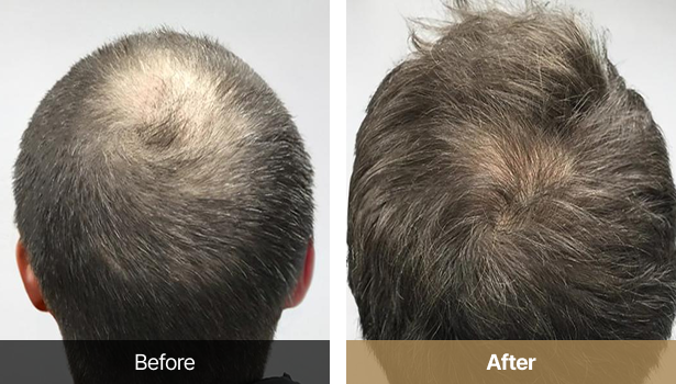 시술전후이미지