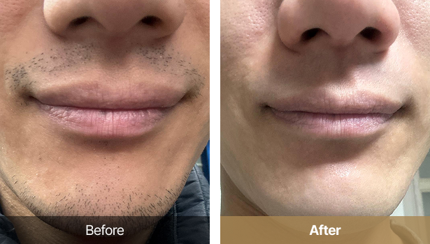 시술전후이미지