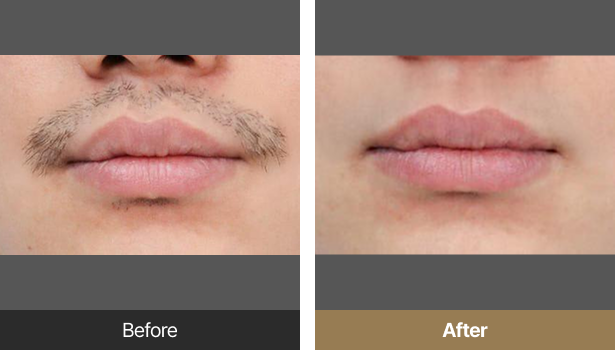 시술전후이미지