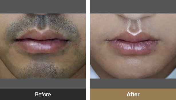 시술전후이미지